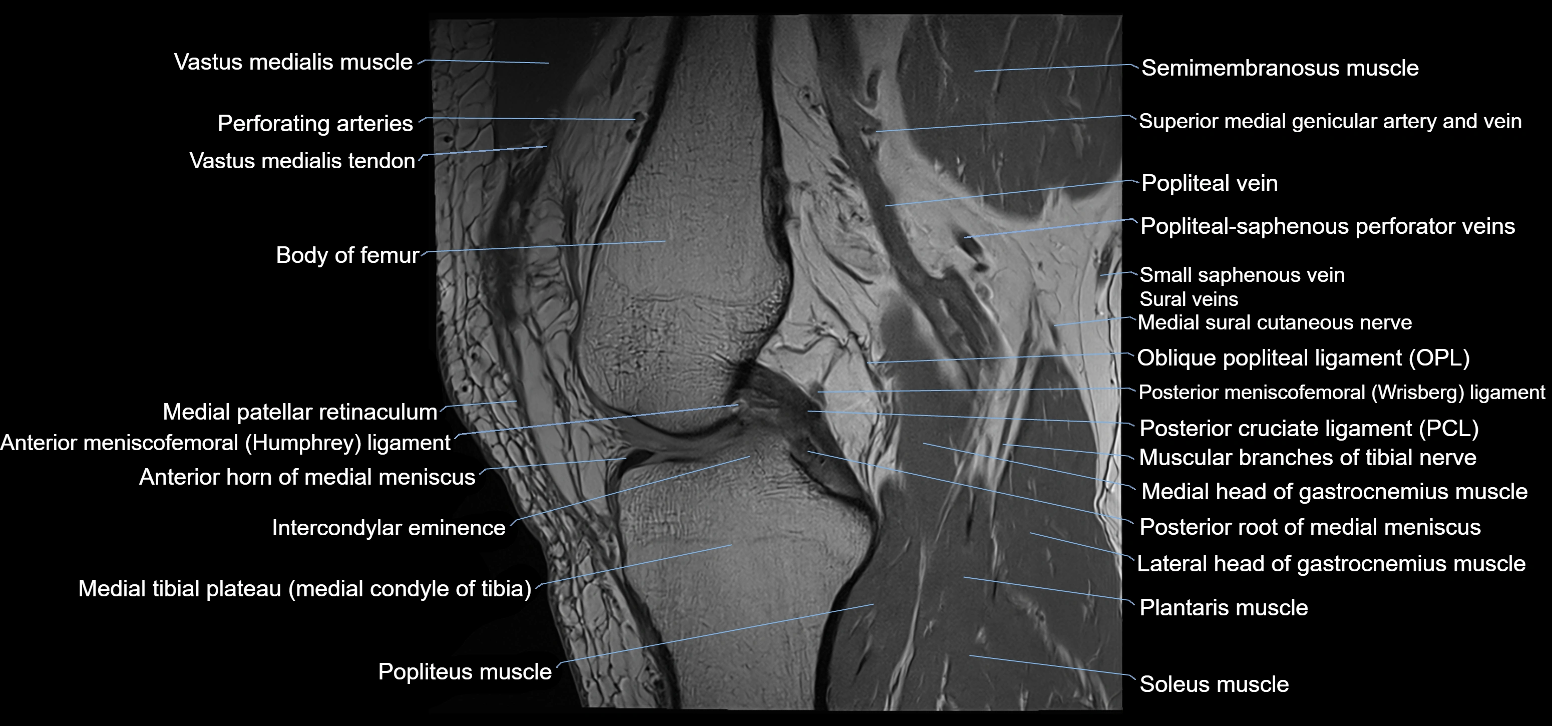 MRI knee sagittal cross sectional anatomy labelled 3T radiology image-00022.webp